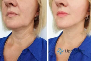 Double chin before and after Hi-Fu treatment 4 Book your double chin treatment Thrapston today! We are here to help!