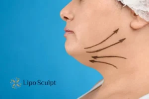 Double chin before and after Hi-Fu treatment 3 Boost your confidence with a Double chin treatment Thrapston