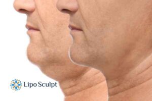 Double chin before and after Hi-Fu treatment 2 Double chin treatment Thrapston from Lipo Sculpt - feel more confident today!