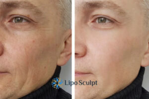 How to Fight Aging Symptoms 3 Fight Aging Symptoms Thrapston With HIFU and Morpheus8 Today!