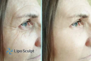 How to Fight Aging Symptoms 2 Do you want to Fight Aging Symptoms Thrapston? Contact Lipo Sculpt today!