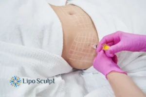 Are The Results From Aqualyx Permanent? 1 Do you want to know how long Aqualyx Thrapston results last?