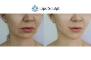 Explaining Total Skin Tightening Treatment And What It Can Do For You 2 Do you want to boost your self confidence? Give Morpheus8 Thrapston a try today!