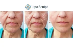 Explaining Total Skin Tightening Treatment And What It Can Do For You 3 Boost your confidence with Morpheus8 Thrapston call our team today!