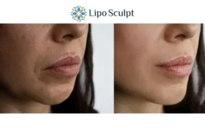 Explaining Total Skin Tightening Treatment And What It Can Do For You 4 Morpheus8 Thrapston the best results - call our team today!