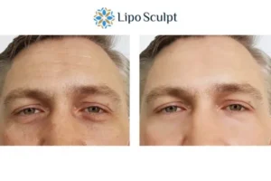 Explaining Total Skin Tightening Treatment And What It Can Do For You 6 Morpheus8 Thrapston book in today to find out more!
