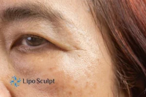 Cryopen: The Revolutionary Treatment for Age Spots Unveiled 2 Are age spots Thrapston giving you low self esteem? Contact us today!