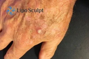 Best Actinic Keratoses Removal 2 Improve your wellbeing and health with Actinic Keratoses Thrapston removal.treatment