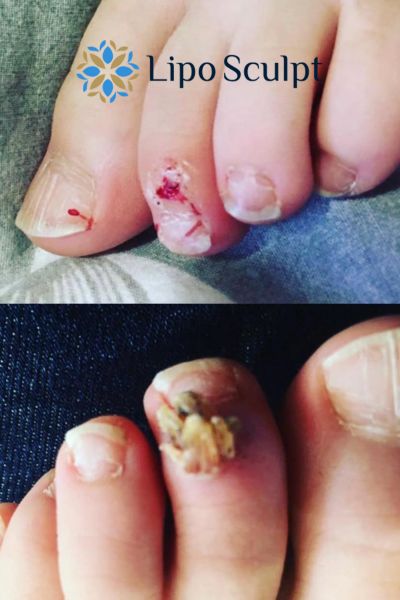 Wart removal customer results from Lipo Sculpt Thrapston