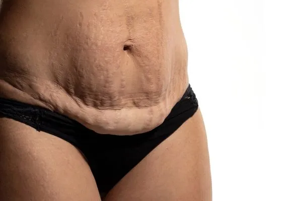 Lost the Weight but Not the Loose Skin? 1 image of womans stomach after weight loss showing loose skin Thrapston